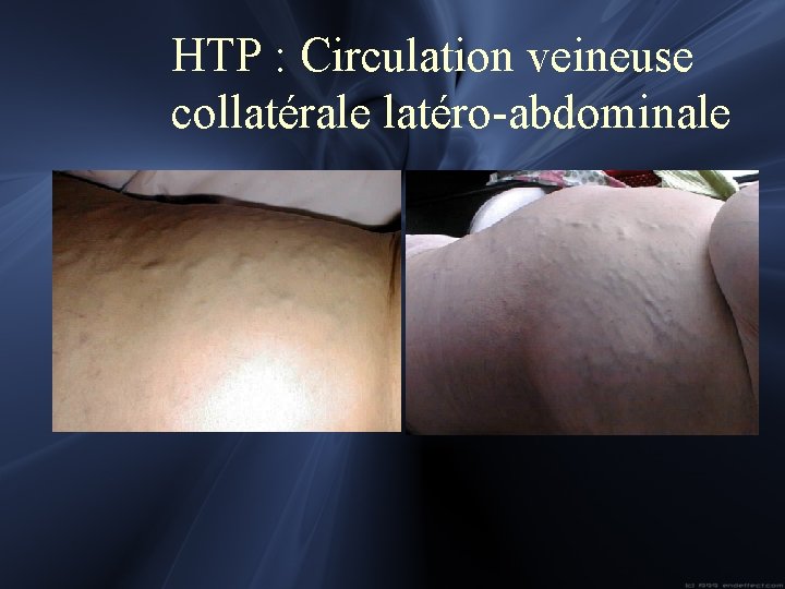 HTP : Circulation veineuse collatérale latéro-abdominale 