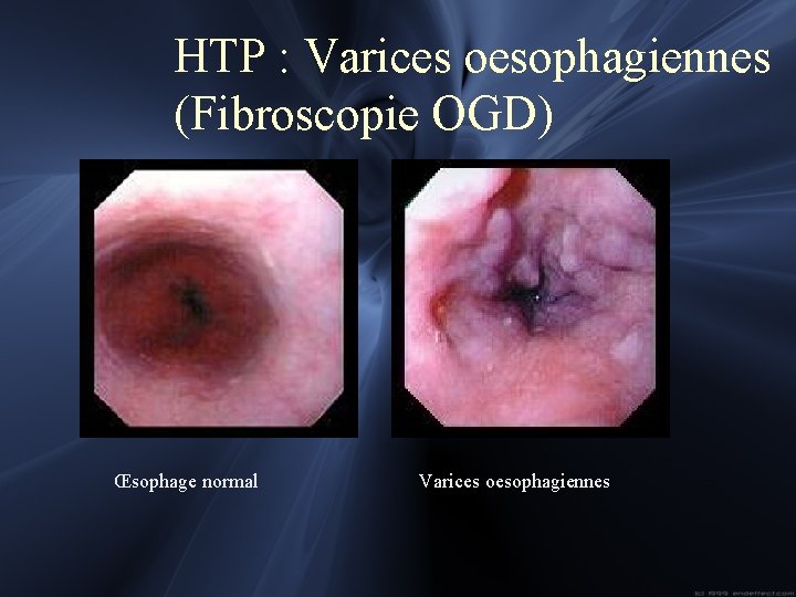 HTP : Varices oesophagiennes (Fibroscopie OGD) Œsophage normal Varices oesophagiennes 