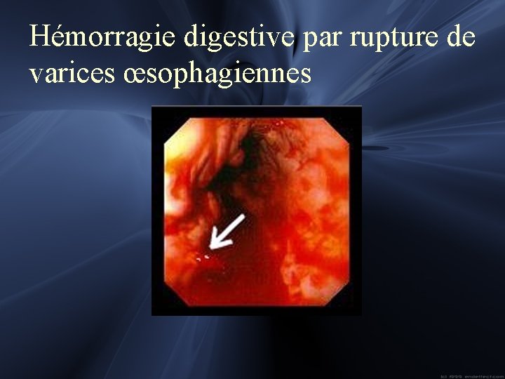 Hémorragie digestive par rupture de varices œsophagiennes 