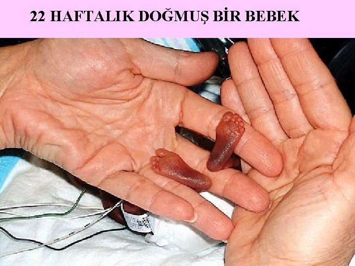 22 HAFTALIK DOĞMUŞ BİR BEBEK 