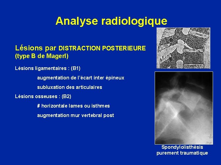 Analyse radiologique Lésions par DISTRACTION POSTERIEURE (type B de Magerl) Lésions ligamentaires : (B