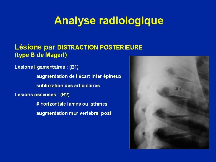 Analyse radiologique Lésions par DISTRACTION POSTERIEURE (type B de Magerl) Lésions ligamentaires : (B