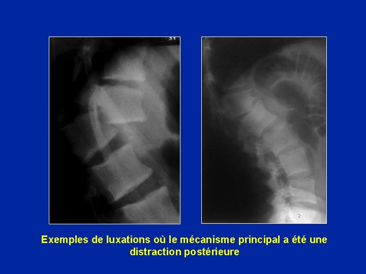 Exemples de luxations où le mécanisme principal a été une distraction postérieure 