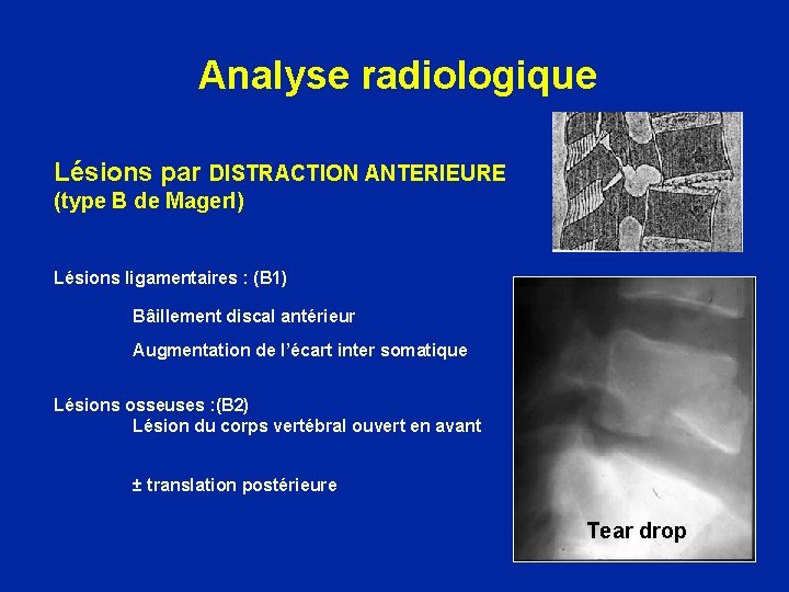 Analyse radiologique Lésions par DISTRACTION ANTERIEURE (type B de Magerl) Lésions ligamentaires : (B