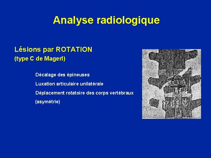 Analyse radiologique Lésions par ROTATION (type C de Magerl) Décalage des épineuses Luxation articulaire