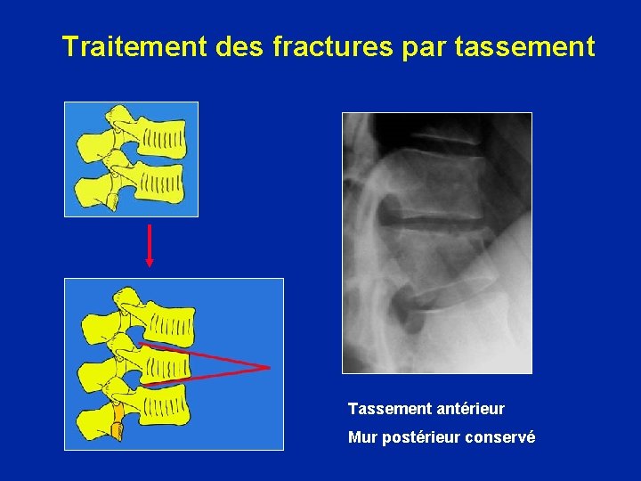 Traitement des fractures par tassement Tassement antérieur Mur postérieur conservé 