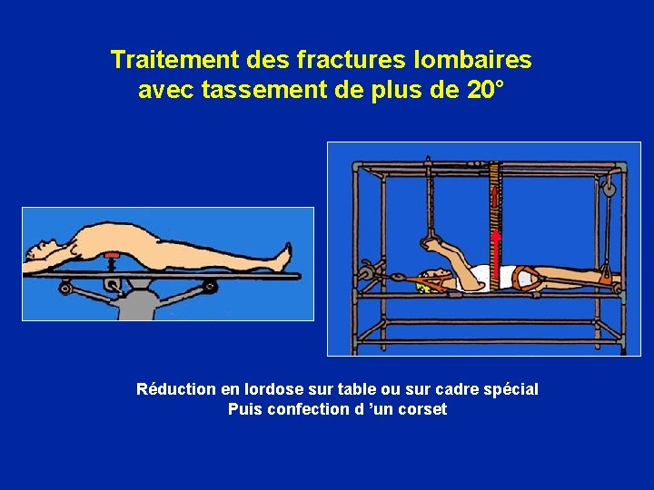 Traitement des fractures lombaires avec tassement de plus de 20° Réduction en lordose sur