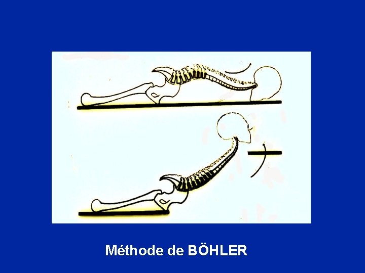 Méthode de BÖHLER 