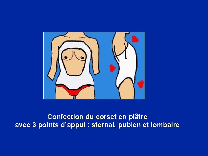 Confection du corset en plâtre avec 3 points d’appui : sternal, pubien et lombaire