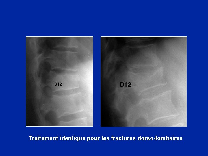 Traitement identique pour les fractures dorso-lombaires 