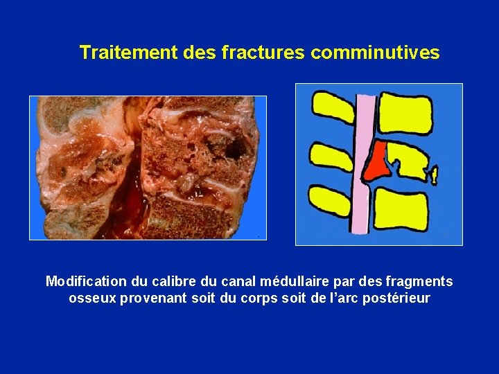 Traitement des fractures comminutives Modification du calibre du canal médullaire par des fragments osseux