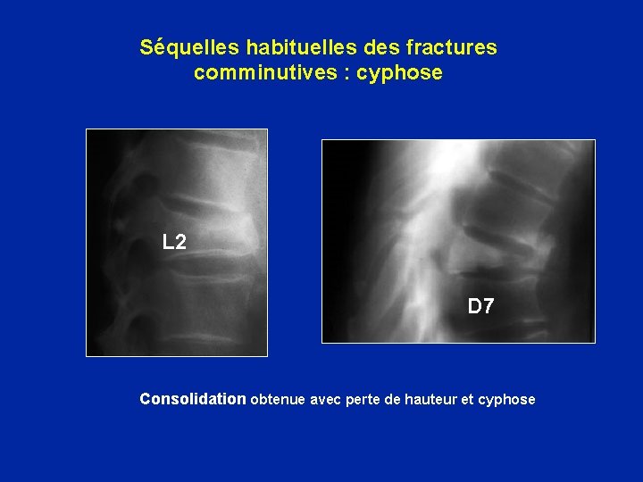 Séquelles habituelles des fractures comminutives : cyphose L 2 D 7 Consolidation obtenue avec