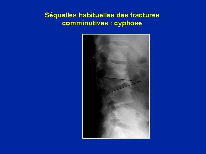 Séquelles habituelles des fractures comminutives : cyphose 