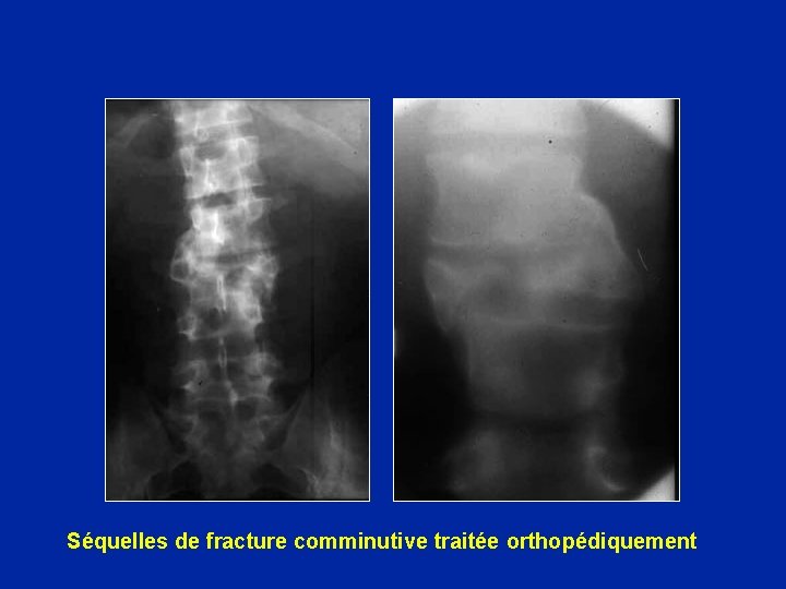 Séquelles de fracture comminutive traitée orthopédiquement 