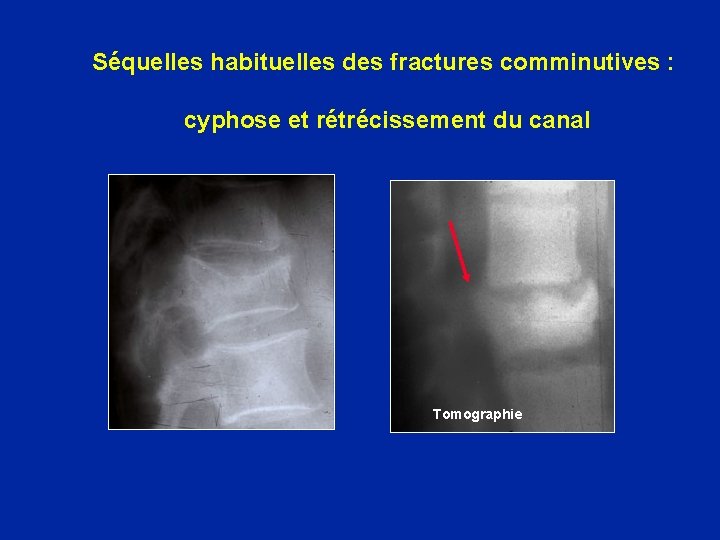 Séquelles habituelles des fractures comminutives : cyphose et rétrécissement du canal Tomographie 