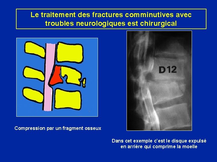 Le traitement des fractures comminutives avec troubles neurologiques est chirurgical Compression par un fragment