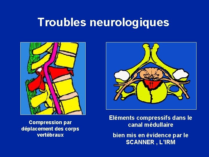 Troubles neurologiques Compression par déplacement des corps vertébraux Eléments compressifs dans le canal médullaire