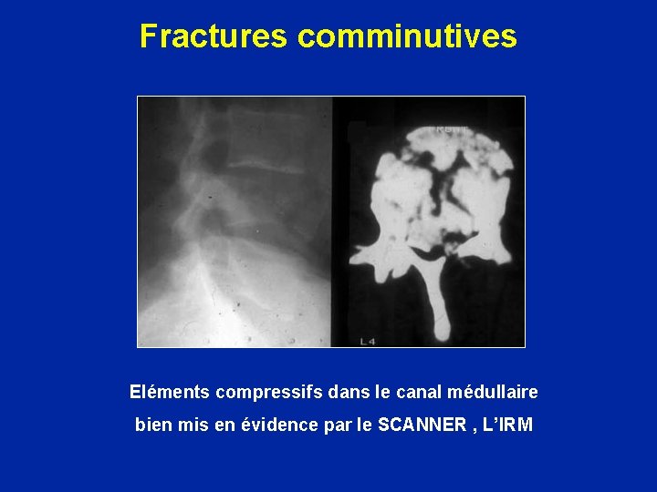 Fractures comminutives Eléments compressifs dans le canal médullaire bien mis en évidence par le