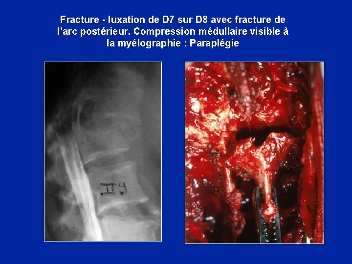 Fracture - luxation de D 7 sur D 8 avec fracture de l’arc postérieur.