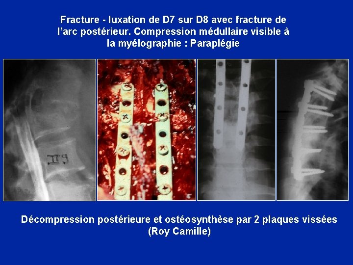 Fracture - luxation de D 7 sur D 8 avec fracture de l’arc postérieur.