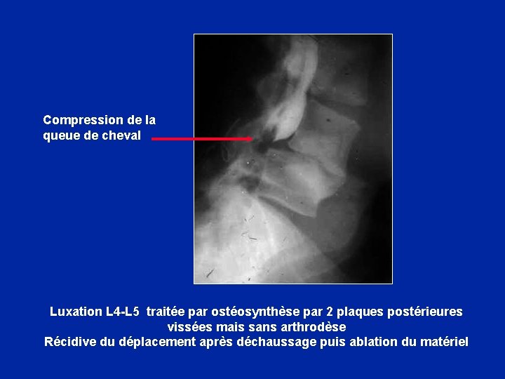 Compression de la queue de cheval Luxation L 4 -L 5 traitée par ostéosynthèse