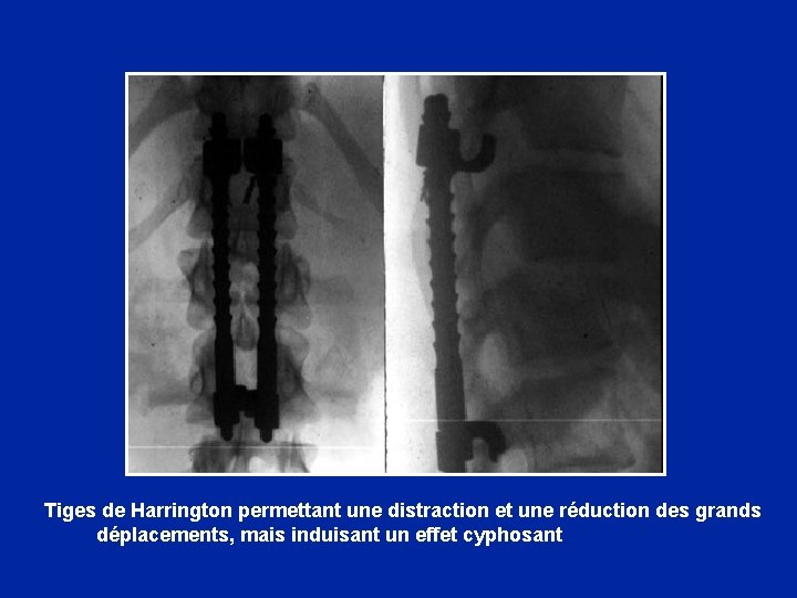  Tiges de Harrington permettant une distraction et une réduction des grands déplacements, mais