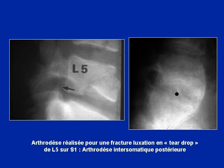 Arthrodèse réalisée pour une fracture luxation en « tear drop » de L 5