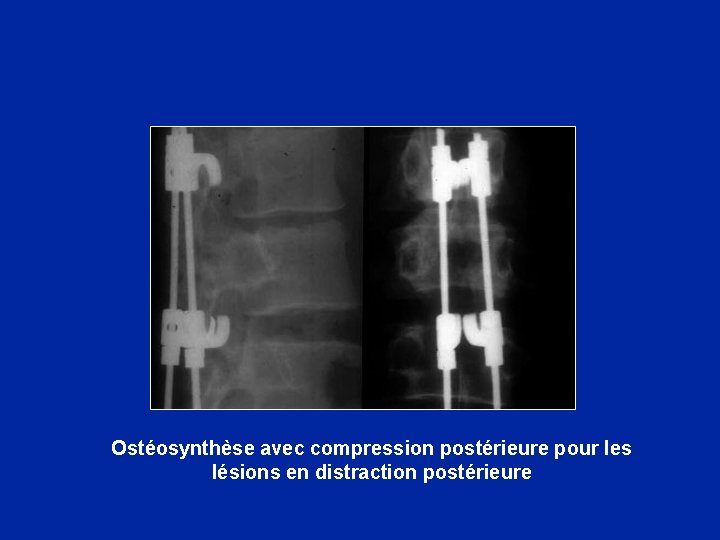 Ostéosynthèse avec compression postérieure pour les lésions en distraction postérieure 