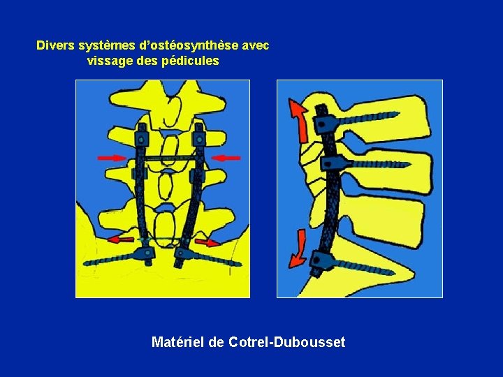 Divers systèmes d’ostéosynthèse avec vissage des pédicules Matériel de Cotrel-Dubousset 