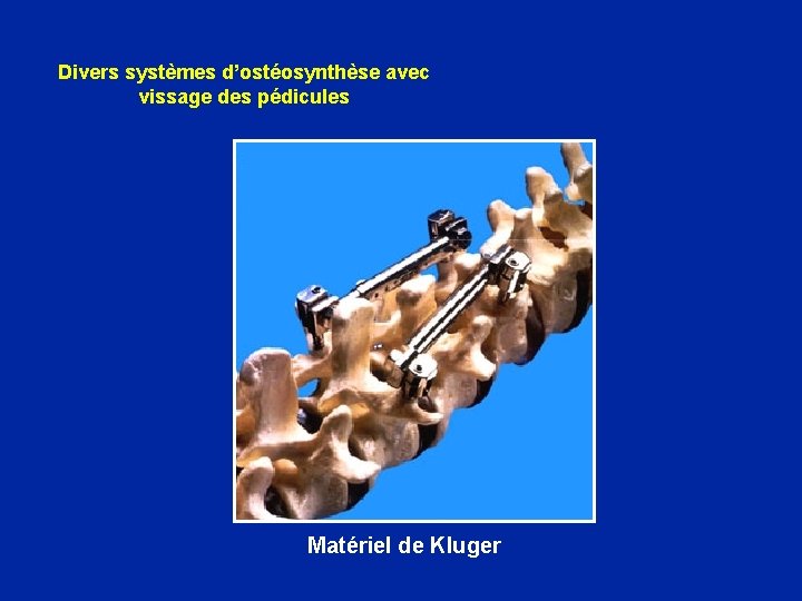 Divers systèmes d’ostéosynthèse avec vissage des pédicules Matériel de Kluger 