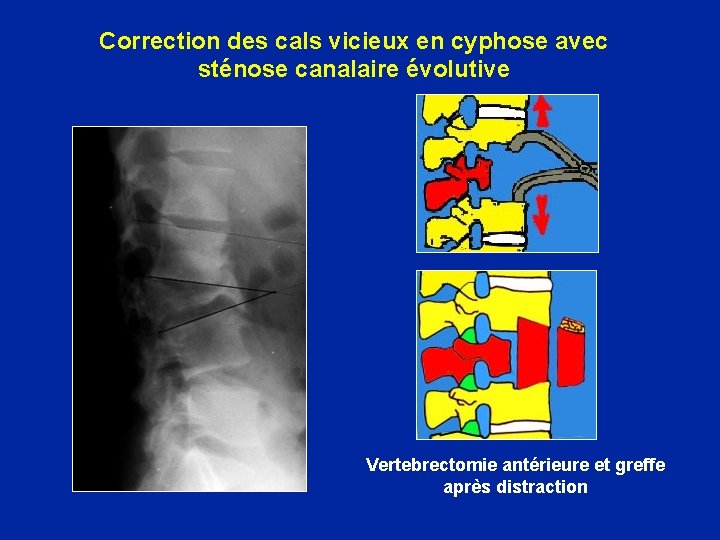 Correction des cals vicieux en cyphose avec sténose canalaire évolutive Vertebrectomie antérieure et greffe