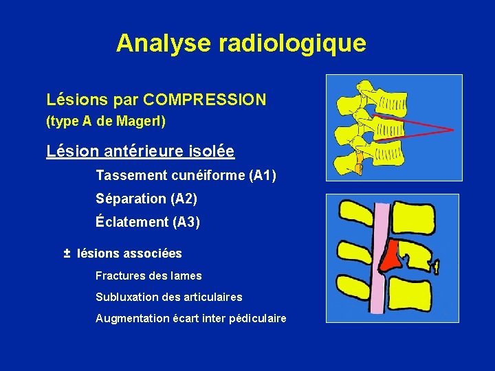 Analyse radiologique Lésions par COMPRESSION (type A de Magerl) Lésion antérieure isolée Tassement cunéiforme