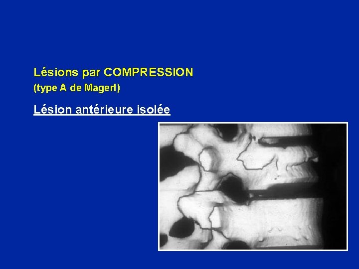 Lésions par COMPRESSION (type A de Magerl) Lésion antérieure isolée 