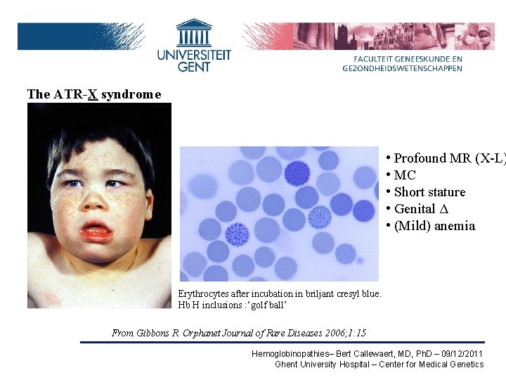 The ATR-X syndrome • Profound MR (X-L) • MC • Short stature • Genital