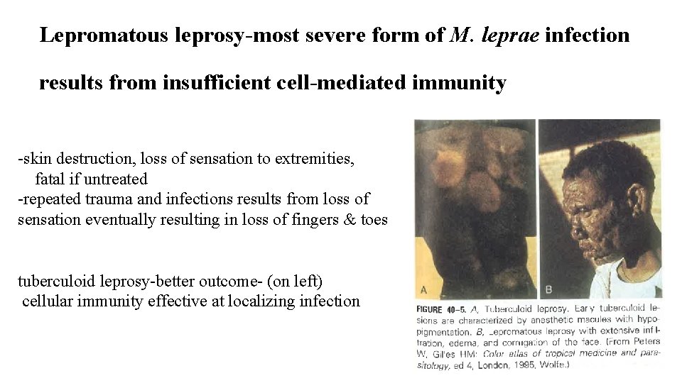 Lepromatous leprosy-most severe form of M. leprae infection results from insufficient cell-mediated immunity -skin