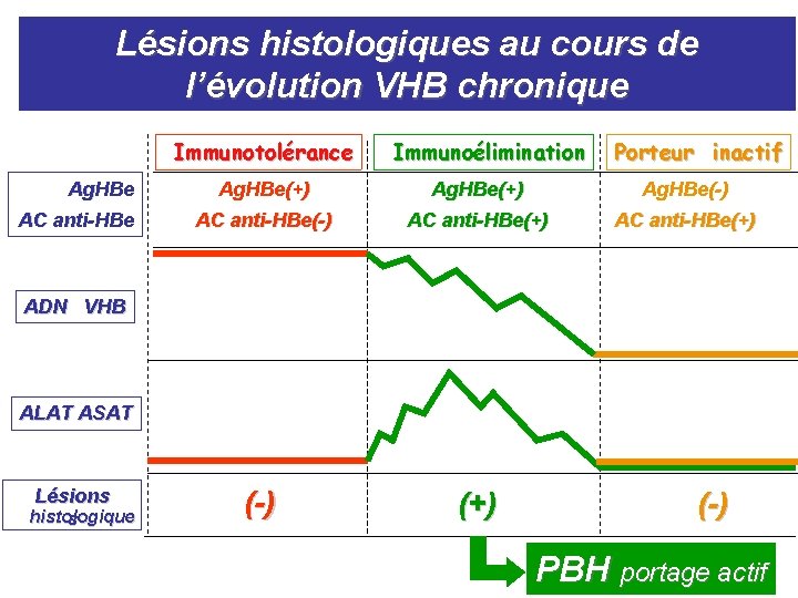 Lésions histologiques au cours de l’évolution VHB chronique Immunotolérance Ag. HBe AC anti-HBe Immunoélimination Lésions histologiques au cours de l’évolution VHB chronique Immunotolérance Ag. HBe AC anti-HBe Immunoélimination