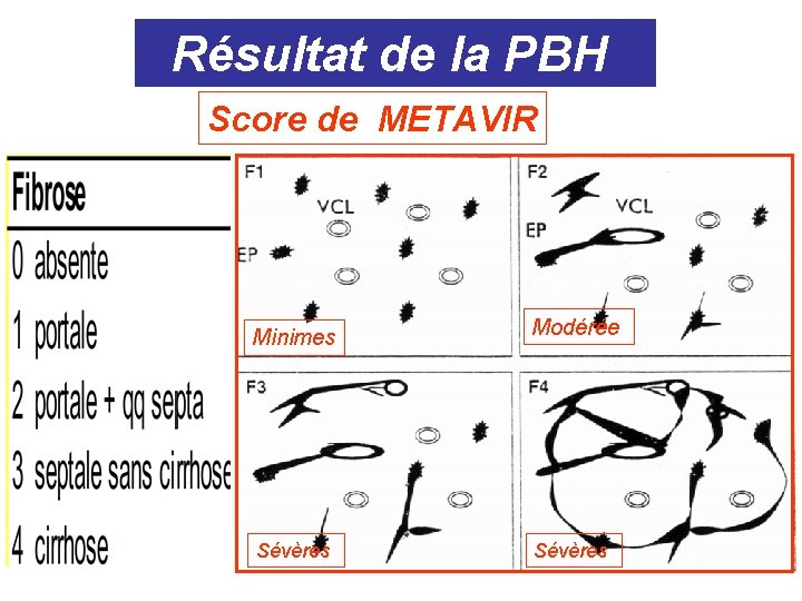 Résultat de la PBH Score de METAVIR Fibrose : Minimes Sévères Modérée Sévères Résultat de la PBH Score de METAVIR Fibrose : Minimes Sévères Modérée Sévères