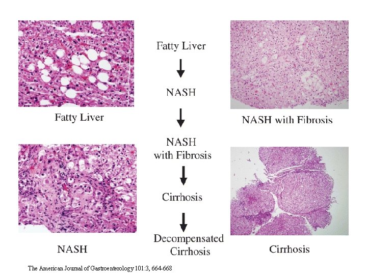 The American Journal of Gastroenterology 101: 3, 664 -668 