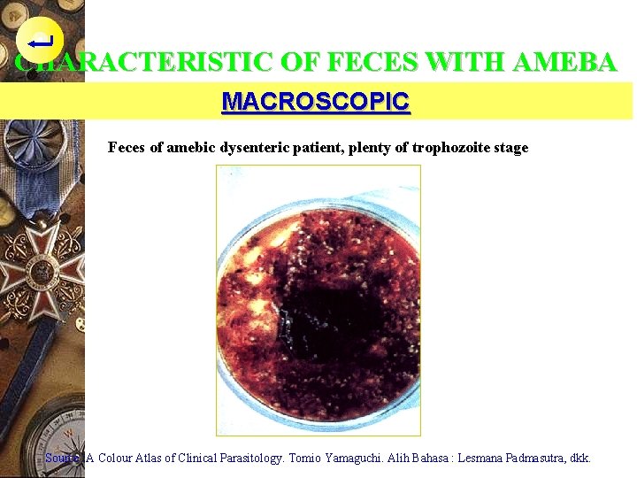 CHARACTERISTIC OF FECES WITH AMEBA MACROSCOPIC Feces of amebic dysenteric patient, plenty of trophozoite