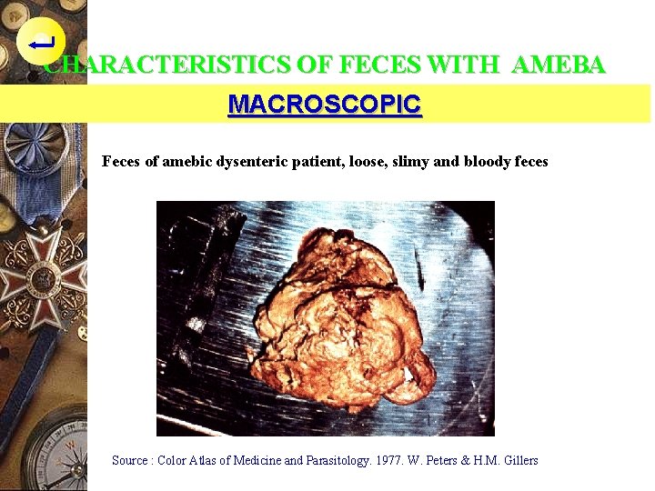 CHARACTERISTICS OF FECES WITH AMEBA MACROSCOPIC Feces of amebic dysenteric patient, loose, slimy and