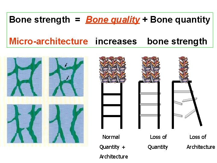 Bone strength = Bone quality + Bone quantity Micro-architecture increases bone strength Normal Loss