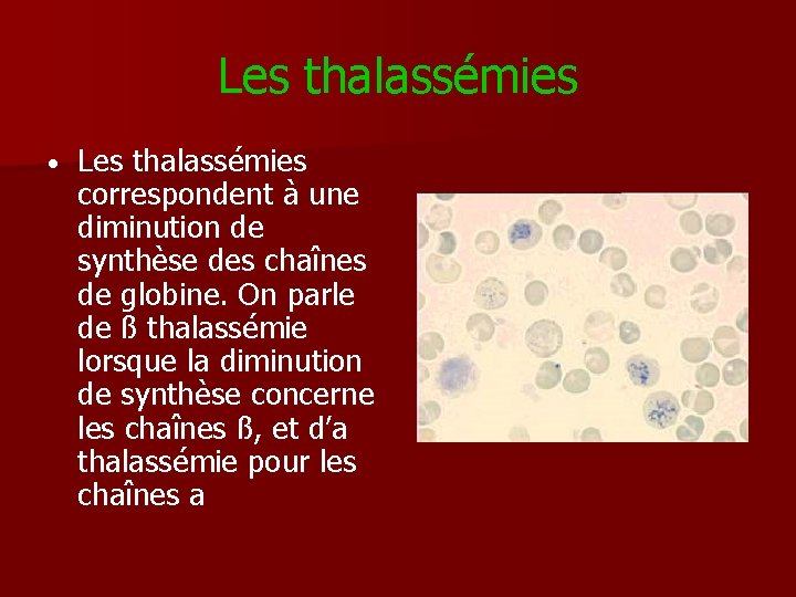 Les thalassémies • Les thalassémies correspondent à une diminution de synthèse des chaînes de