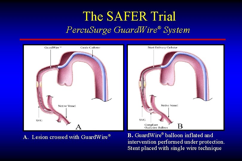 The SAFER Trial Percu. Surge Guard. Wire® System A. Lesion crossed with Guard. Wire®