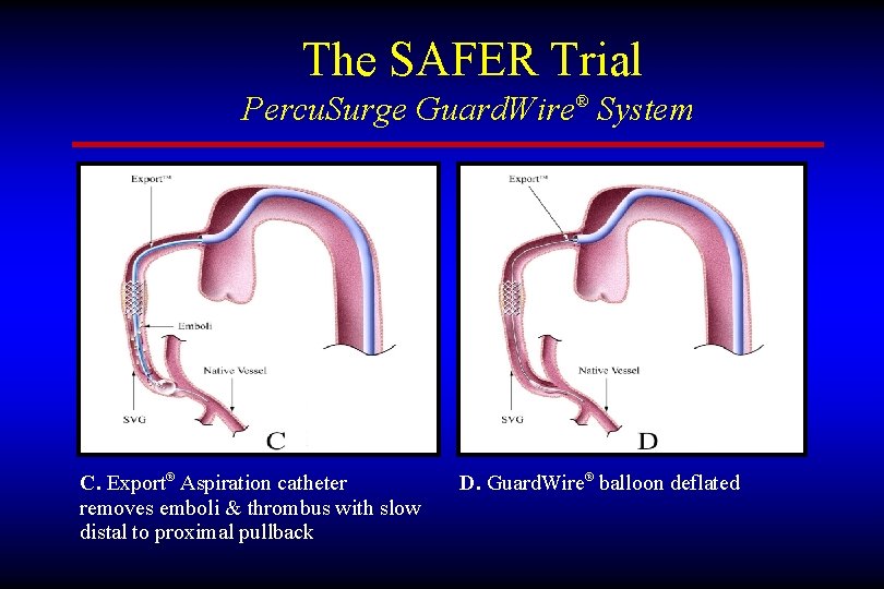 The SAFER Trial Percu. Surge Guard. Wire® System C. Export® Aspiration catheter removes emboli