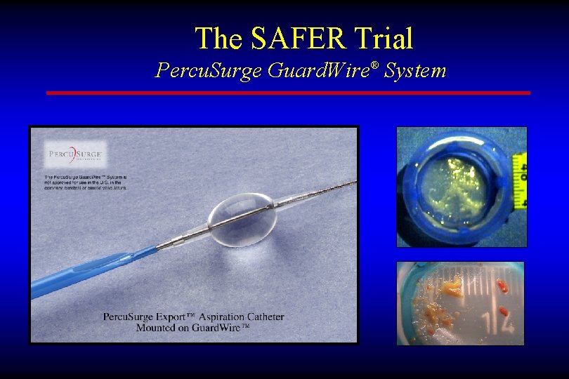 The SAFER Trial Percu. Surge Guard. Wire® System 