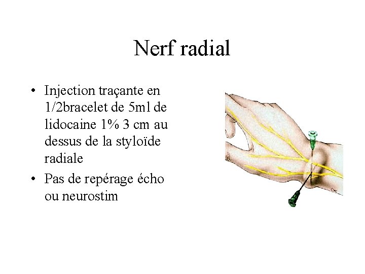 Nerf radial • Injection traçante en 1/2 bracelet de 5 ml de lidocaine 1%