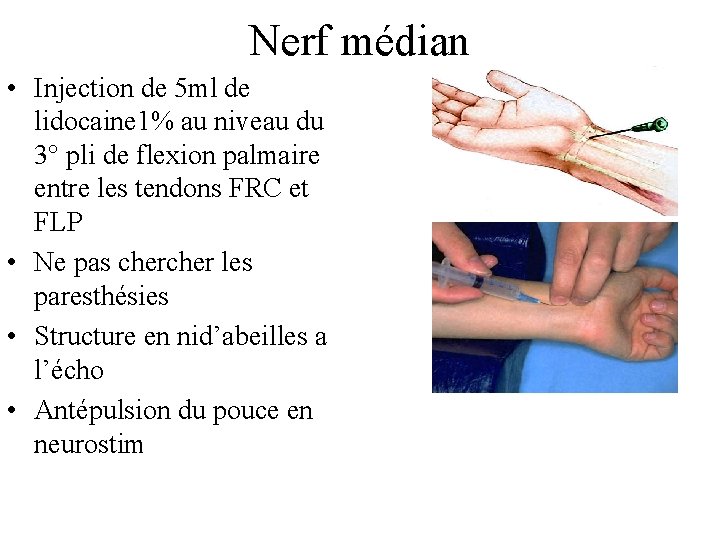 Nerf médian • Injection de 5 ml de lidocaine 1% au niveau du 3°