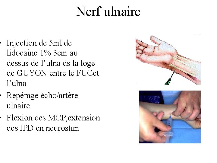 Nerf ulnaire • Injection de 5 ml de lidocaine 1% 3 cm au dessus