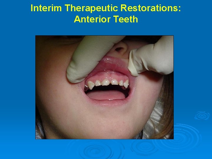 Interim Therapeutic Restorations: Anterior Teeth 