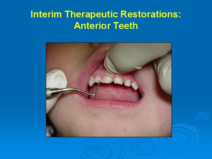 Interim Therapeutic Restorations: Anterior Teeth 